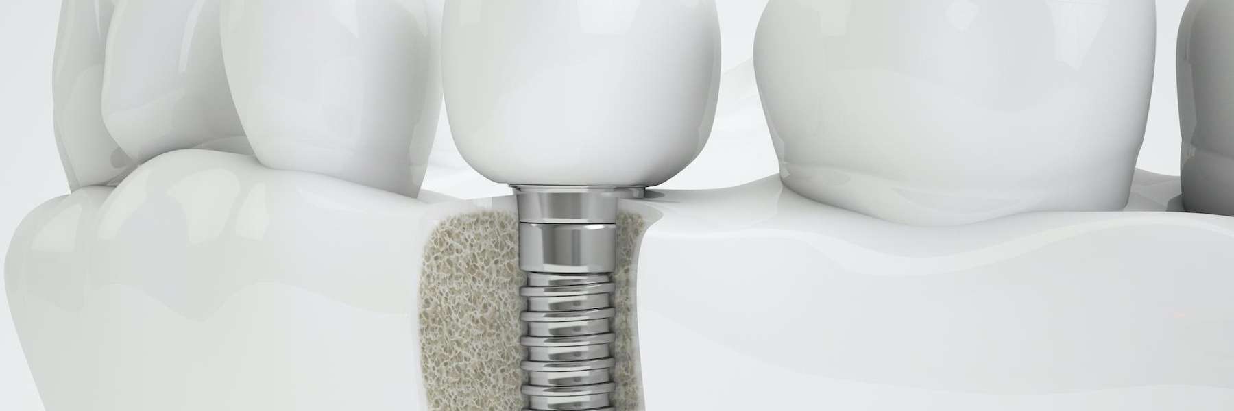 Dental implant in St Cloud FL
