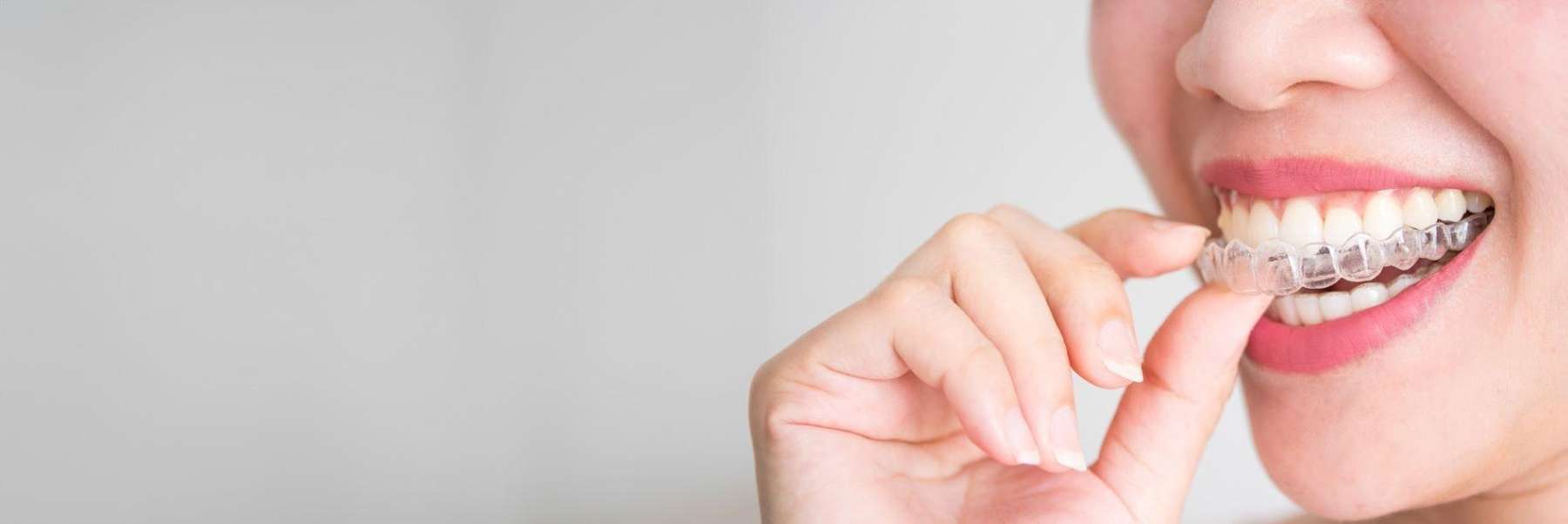 close-up of clear aligner user in St Cloud FL
