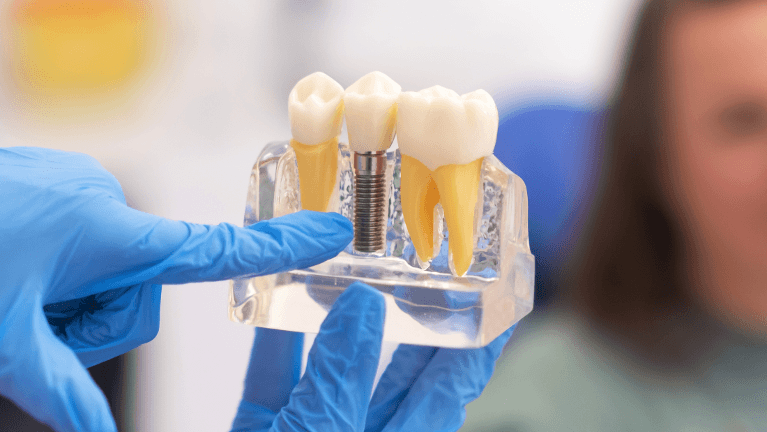 dental implants st cloud fl