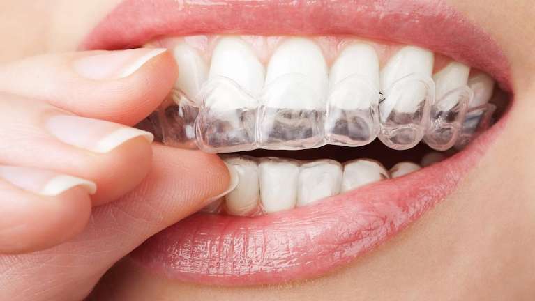 An image of a person's open mouth with teeth visible and an invisible braces