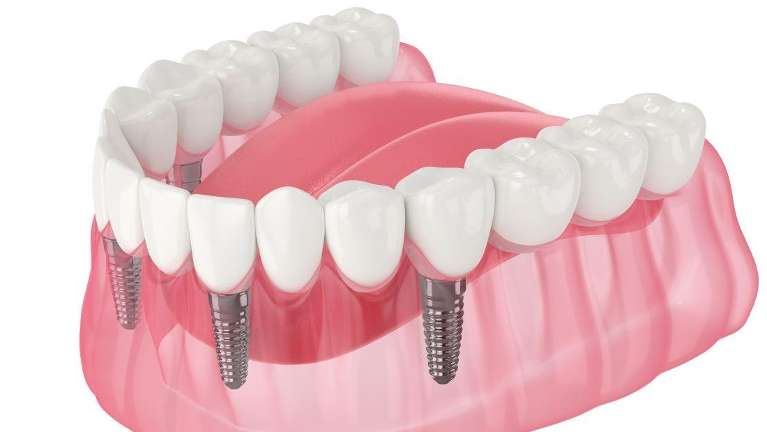 Permanent dentures in St. Cloud FL