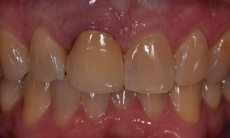 ceramic crowns st cloud fl