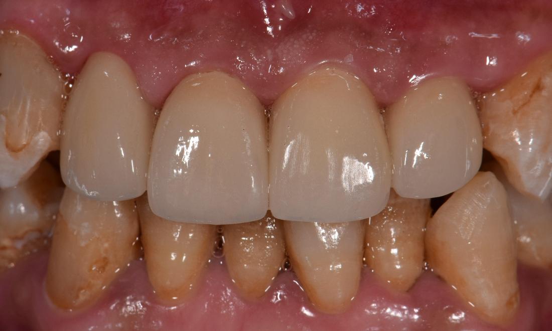 patients damaged tooth after ceramic crowns in modern dentistry st. cloud