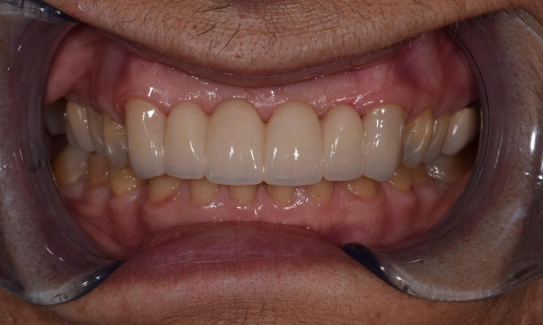 after ceramic crowns in modern dentistry of st. cloud