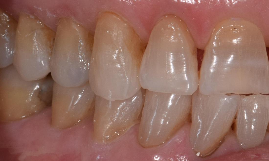 after tooth colored fillings st cloud fl