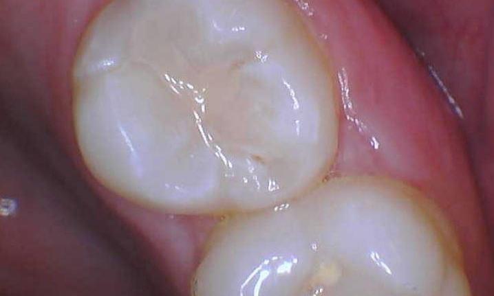 tooth colored fillings st cloud fl