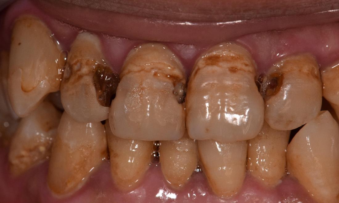 patients damaged tooth before ceramic crowns in modern dentistry st. cloud