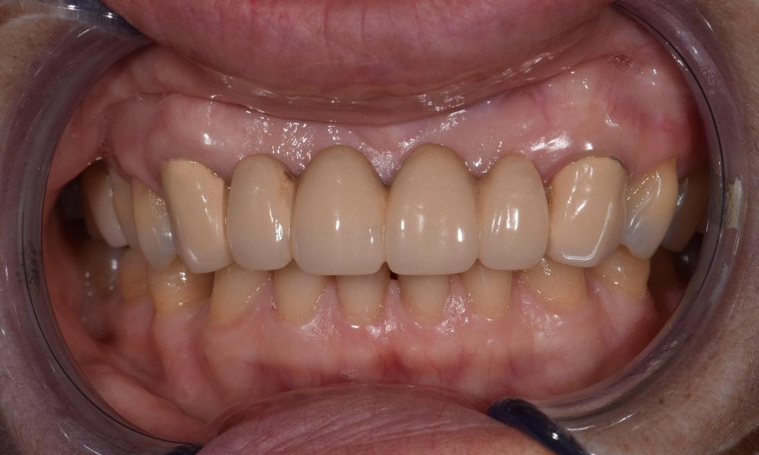 before ceramic crowns in modern dentistry of st. cloud