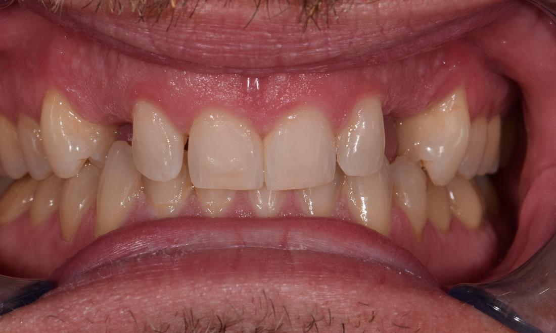 before adding 2 ceramic crowns in st. cloud fl