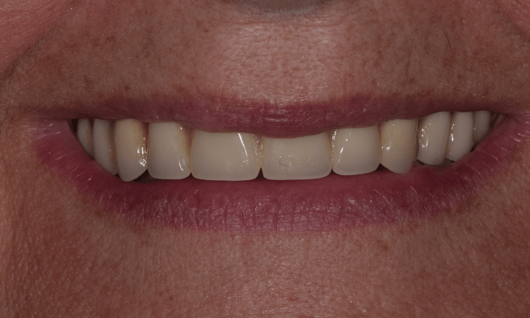 before complete dentures st. cloud fl