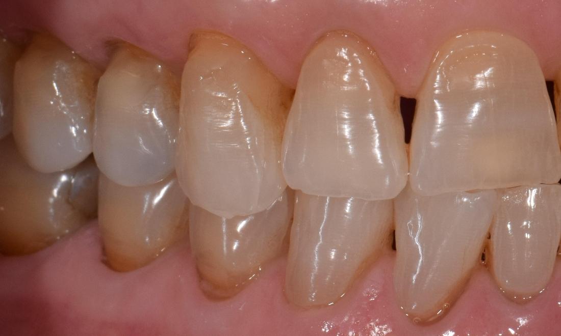 before tooth colored fillings st cloud fl
