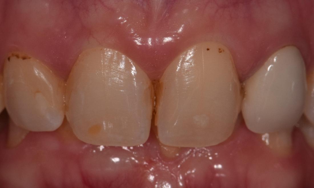 before tooth colored fillings st cloud fl