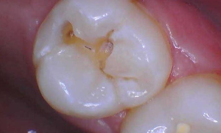 cavity in tooth | st cloud fl