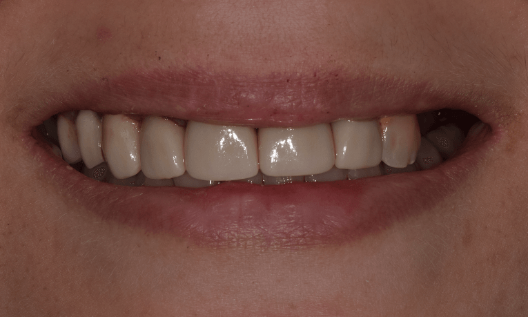 all ceramic crowns st cloud fl