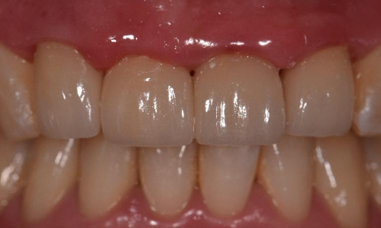 full smile makeover | ceramic crowns st cloud fl