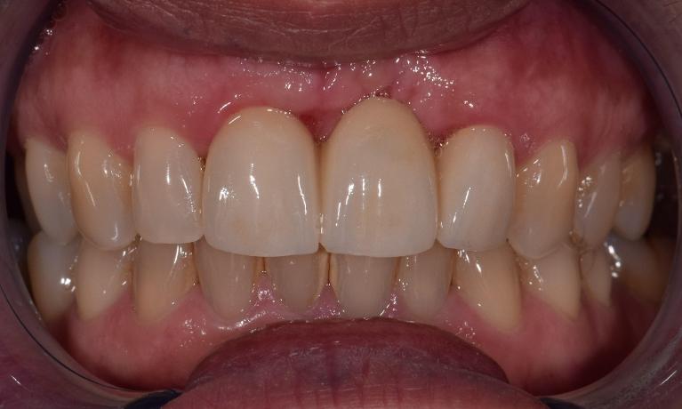 after ceramic crown in st. cloud fl