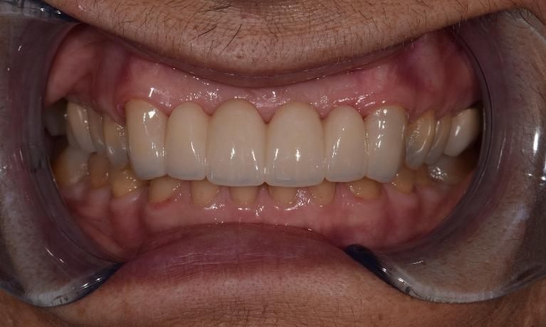Ceramic-Crowns-After-Image