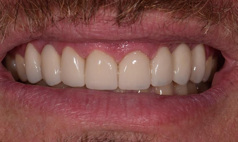 after adding 2 ceramic crowns in st. cloud fl