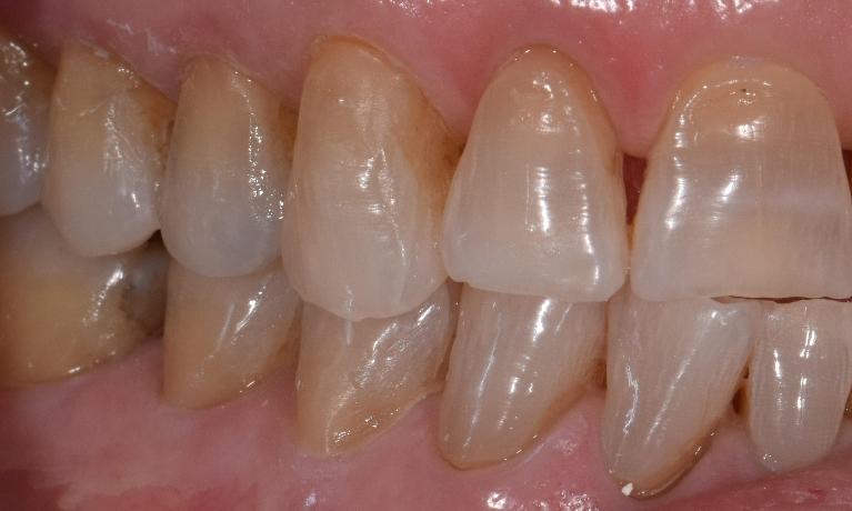 Composite-Fillings-After-Image