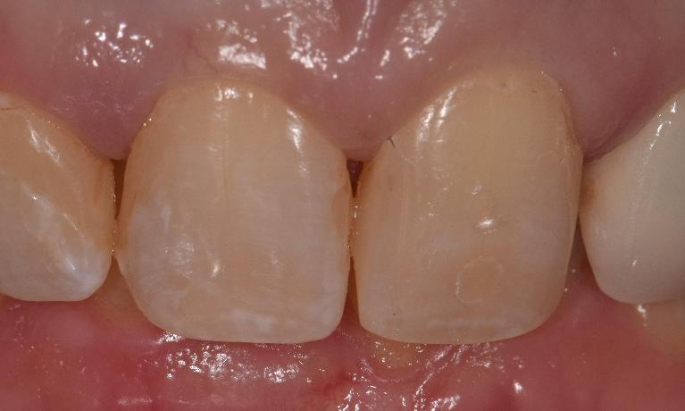 Composite-Resins-After-Image