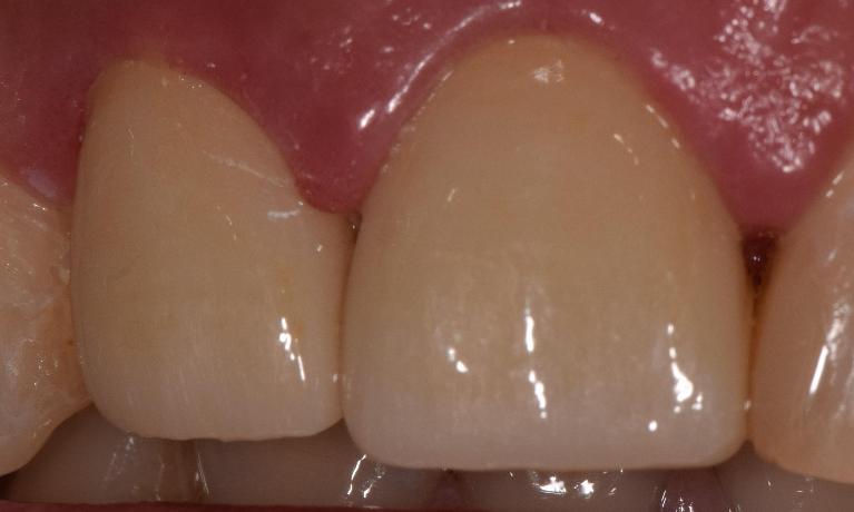 porcelain crowns st. cloud fl