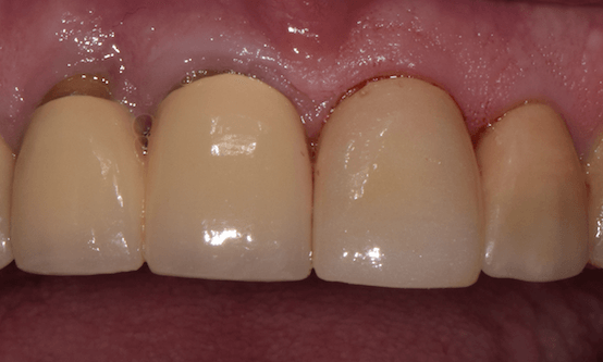 ceramic crowns st cloud fl