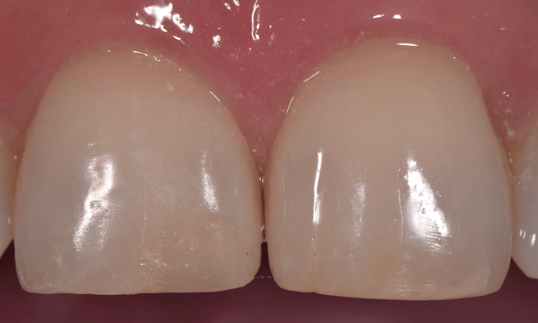 cosmetic dental bonding st cloud fl