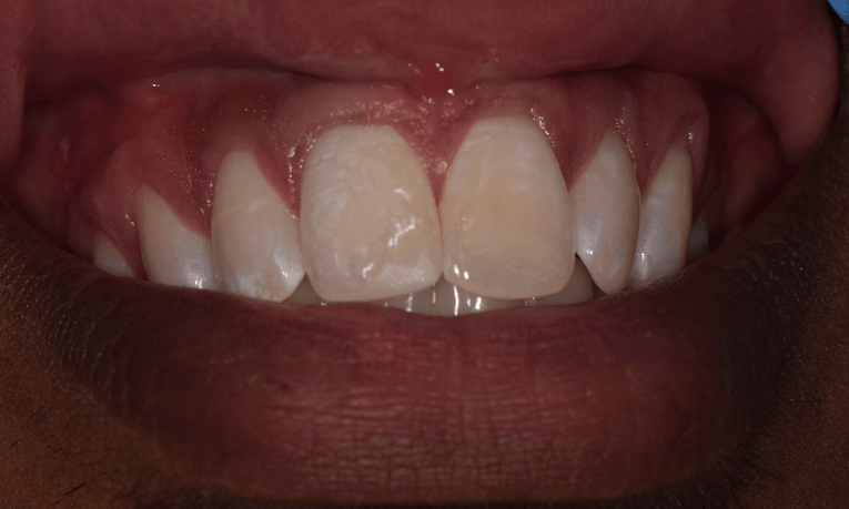 dental bonding st cloud fl