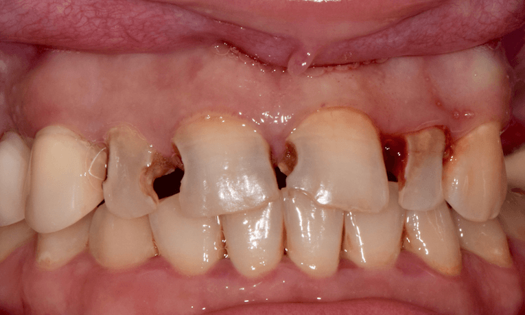 decayed front teeth st cloud fl