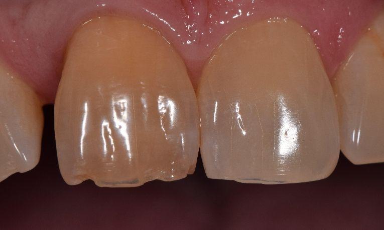 discolored and chipped teeth st cloud fl