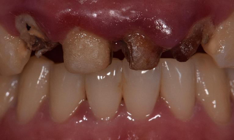 infected, broken teeth st cloud fl