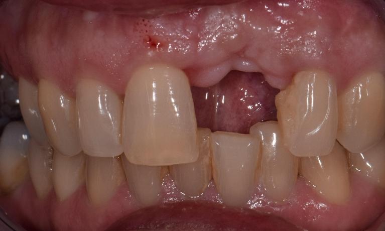 before ceramic crown in st. cloud fl