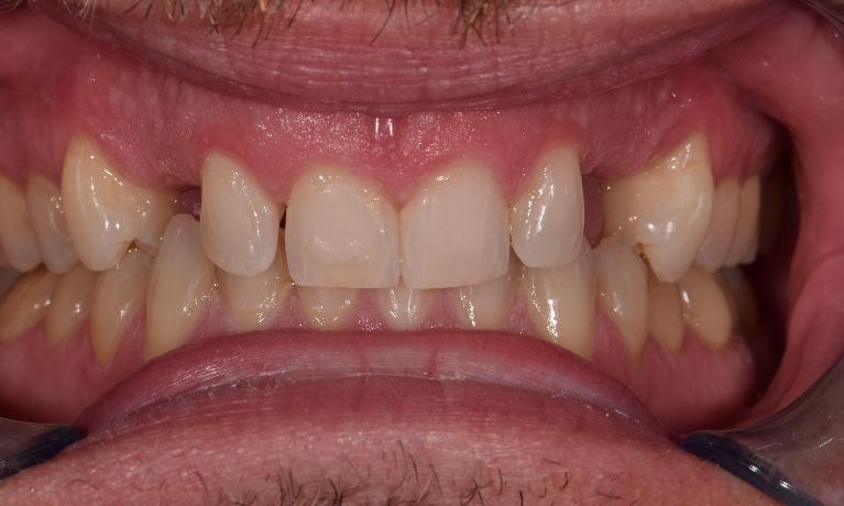 before adding 2 ceramic crowns in st. cloud fl