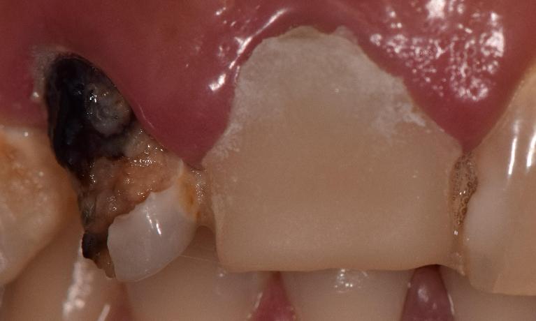 infected, chipped teeth st cloud fl