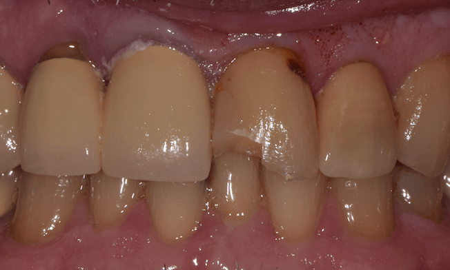 broken metal crown st cloud flo