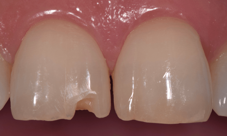 chipped tooth st cloud fl