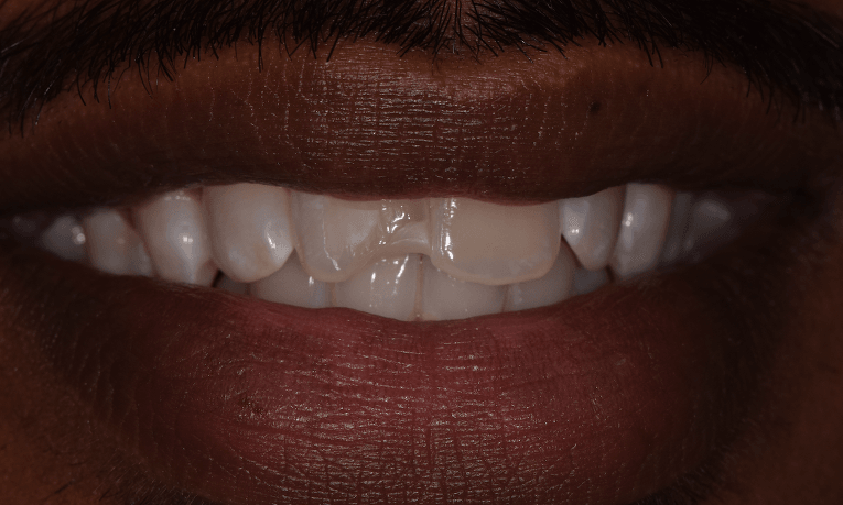 broken tooth st cloud fl